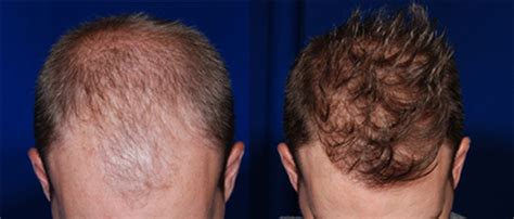Hair Transplantation St. Louis .